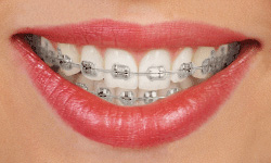 Types of Braces - Kids Dental Online - Plano & Carrollton